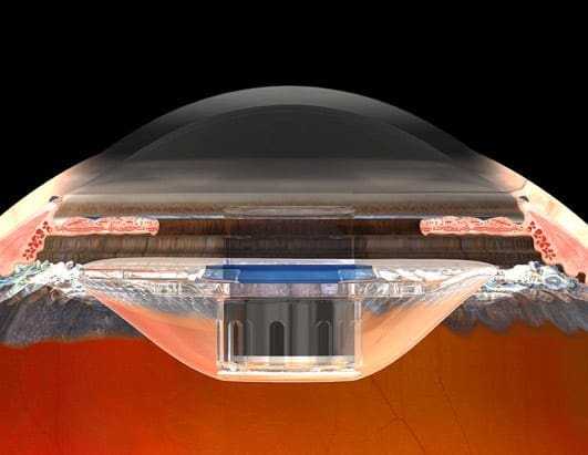 Βιονικά μάτια; Έρχονται στο κοντινό σας… πολυιατρείο!