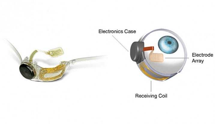 Τεχνητή ‘ίριδα’: έλαβε έγκριση στην Ευρώπη..