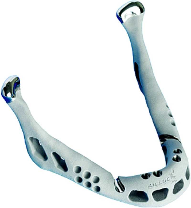 Το πρώτο ‘οστό’ από τιτάνιο…