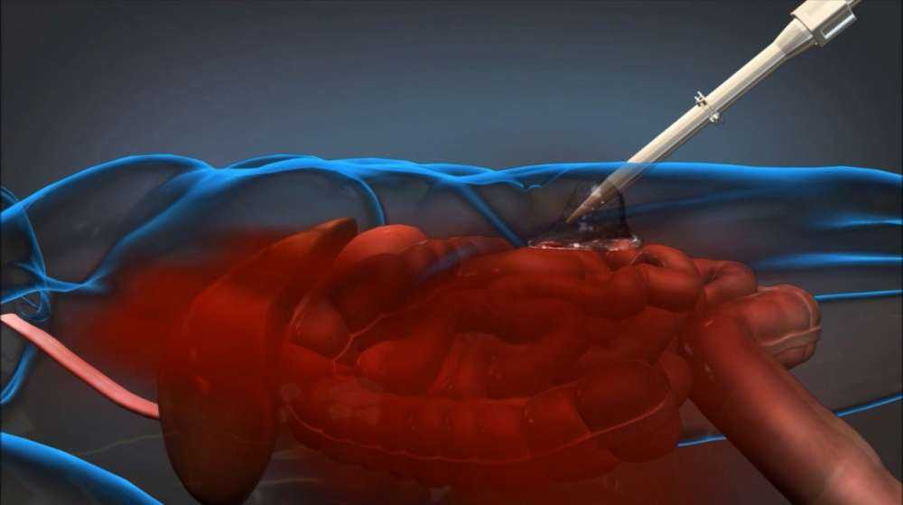 Darpa – ετοίμασε ειδικό αφρό για την αιμοραγία!